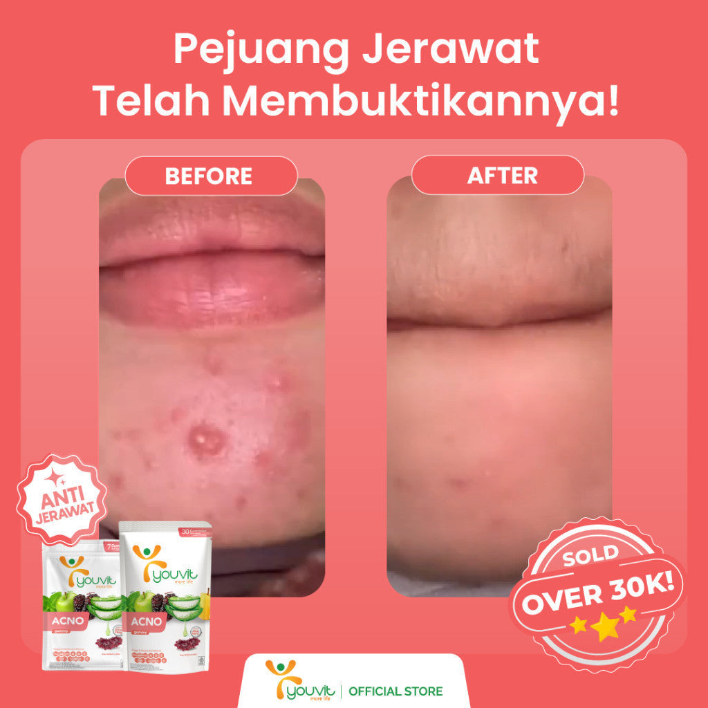 Niacinamide Gummy untuk Anti Jerawat | Youvit AcNO 30 Hari dengan Vitamin A (Alternatif Retinol)