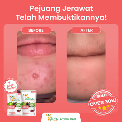 Niacinamide Gummy untuk Anti Jerawat | Youvit AcNO 30 Hari dengan Vitamin A (Alternatif Retinol)