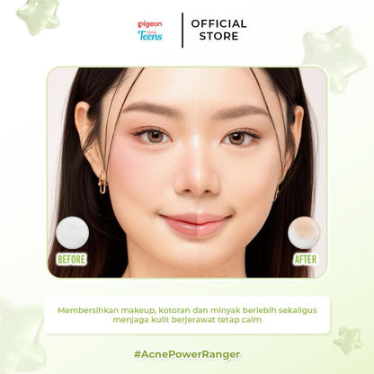 Pigeon Teens Acne Ranger Micellar Water | Micellar Water Remaja untuk Kulit Berjerawat | Membersihkan Makeup & Minyak Berlebih | Refreshing, Lightweight & Alcohol Free